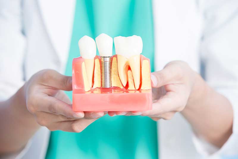 Dentist showing the dental implant modal