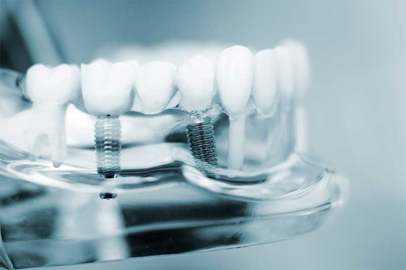 All in four dental implants