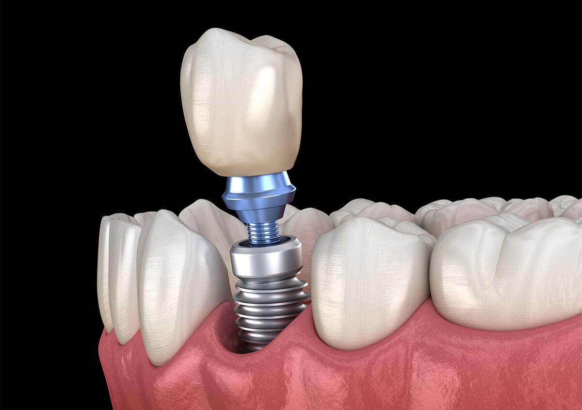 Teeth Implants in Montgomeryville PA Area